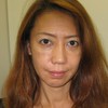 DR　近藤　こだわりのコンデンス脂肪幹細胞注入　目の下　法令線　口角