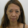 DR　近藤　こだわりのコンデンス脂肪幹細胞注入　目の下　法令線　口角
