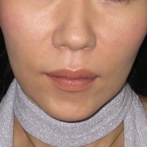 DR 近藤　こだわりのラディエッセ注入　法令線