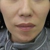 DR 近藤　こだわりのラディエッセ注入　法令線