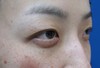 DR近藤　こだわりの目頭切開（マイクロサージャリー　顕微鏡手術）