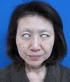 DR　近藤オリジナル　切らないお顔の引き上げ術　チタンペックリフト