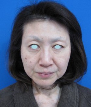 DR　近藤オリジナル　切らないお顔の引き上げ術　チタンペックリフト
