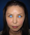 私の目指す美容医療　MIAS：　DR近藤オリジナル切らないお顔の引き上げ術　チタンペックリフト　＋　自分の血液から作るゲル（PPP-GEL）のチークへの注入