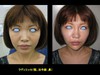 プチ整形でこんなにすっきり！　DR 近藤　こだわりのラディエッセ注入　顎　法令線
