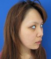 自分の血液から作るPPP-GEL(プラズマジェル)の注入で　活き活きチーク！！　 ＋　アゴのラディエッセ注入