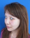 自分の血液から作るPPP-GEL(プラズマジェル)の注入で　活き活きチーク！！　 ＋　アゴのラディエッセ注入