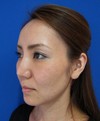 素敵な人がより素敵に！　モデルは当院スタッフ その１　自分の血液から作るPPP-GEL(プラズマジェル)の注入で　活き活きチーク！！　  