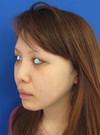 自分の血液から作るPPP-GEL(プラズマジェル)の注入で　活き活きチーク！！　 ＋　アゴのラディエッセ注入