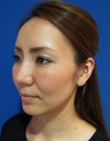 素敵な人がより素敵に！　モデルは当院スタッフ その１　自分の血液から作るPPP-GEL(プラズマジェル)の注入で　活き活きチーク！！　  
