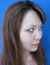自分の血液から作るPPP-GEL(プラズマジェル)の注入で　活き活きチーク！！　 ＋　アゴのラディエッセ注入