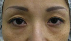 DR近藤オリジナル　切らない目の下のたるみ取り 自己再生TCB