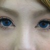 DR. 近藤　こだわりの　目頭切開（蒙古ヒダ除去）術