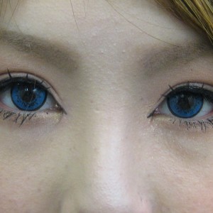 DR. 近藤　こだわりの　目頭切開（蒙古ヒダ除去）術
