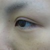 DR近藤　こだわりの目頭切開（蒙古ヒダ除去）術（手術顕微鏡使用）