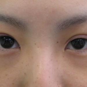 DR. 近藤　こだわりの　目頭切開（蒙古ヒダ除去）術