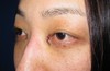 DR.近藤　こだわりの目頭切開（マイクロサージャリー・顕微鏡手術）