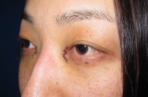 DR.近藤　こだわりの目頭切開（マイクロサージャリー・顕微鏡手術）