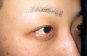 DR. 近藤　こだわりの目頭切開（顕微鏡使用・マイクロサージャリー）