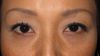 DR近藤オリジナル　切らない目の下のたるみ取り 自己再生TCB
