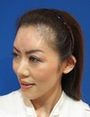 おでこのシワ、おでこの形、とにかく　おでこでお悩の全ての方に： レディエッセ（Radiesse)注入による　プチ整形