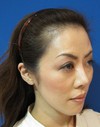 ＊ おでこのシワ、おでこの形、とにかく　おでこでお悩の全ての方に： レディエッセ（Radiesse)注入による　プチ整形