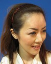 ＊ おでこのシワ、おでこの形、とにかく　おでこでお悩の全ての方に： レディエッセ（Radiesse)注入による　プチ整形