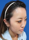 手術でなくても　さりげなく　より美人に！　DR  近藤　こだわりのラディエッセ注入　 お鼻・アゴのプチ整形（注入直後）