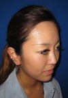手術でなくても　さりげなく　より美人に！　DR  近藤　こだわりのラディエッセ注入　 お鼻・アゴのプチ整形（注入2日後）