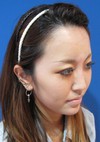 手術でなくても　さりげなく　より美人に！　DR  近藤　こだわりのラディエッセ注入　 お鼻・アゴのプチ整形（注入直後）