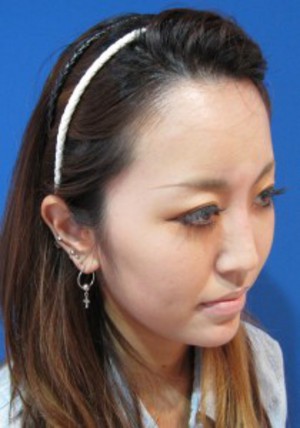手術でなくても　さりげなく　より美人に！　DR  近藤　こだわりのラディエッセ注入　 お鼻・アゴのプチ整形（注入直後）