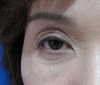 目の上の凹み（奥目）に　お悩みの方に：　DR近藤　こだわりのラディエッセ注入