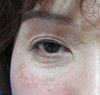 目の上の凹み（奥目）に　お悩みの方に：　DR近藤　こだわりのラディエッセ注入