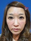 自己血からつくる　PPPーGEL注入による　最新若返り治療：　張りのある活き活きチークに！