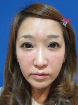 自己血からつくる　PPPーGEL注入による　最新若返り治療：　張りのある活き活きチークに！