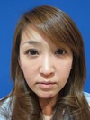 自己血からつくる　PPPーGEL注入による　最新若返り治療：　張りのある活き活きチークに！