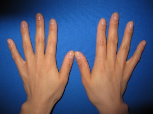 自分の血液から作るGELで　手の若返り！　PPP-GEL注入療法