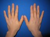 自分の血液から作るGELで　手の若返り！　PPP-GEL注入療法
