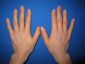 自分の血液から作るGELで　手の若返り！　PPP-GEL注入療法
