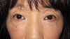 目の下の膨らみと凹みラインが混在した方に:  DR近藤オリジナル　切らない目の下のクマ・たるみ取り　＋　ラディエッセ注入　（TCB-R 法）他院術後再手術