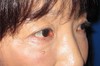 目の下の膨らみと凹みラインが混在した方に:   DR近藤オリジナル　切らない目の下のクマ・たるみ取り　＋　ラディエッセ注入　　（TCB-R 法）他院手術後再手術