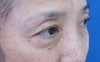 目の下の膨らみと凹みラインが混在した方に:   DR近藤オリジナル　切らない目の下のクマ・たるみ取り　＋　ラディエッセ注入　　（TCB-R 法）他院手術後再手術