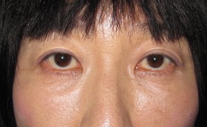目の下の膨らみと凹みが混在した方に　切らない目の下のクマ・たるみ取り　TCB-R　コンプリート法　