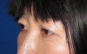 目の下の膨らみと凹みが混在した方に　切らない目の下のクマ・たるみ取り　TCB-R　コンプリート法　