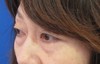 DR　近藤オリジナル　切らない目の下のクマ・たるみ取り　マイクロサージャリー（顕微鏡手術）