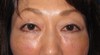 目の下の膨らみと凹みラインが混在した方に:  DR近藤オリジナル　切らない目の下のクマ・たるみ取り　＋　ラディエッセ注入　（TCB-R 法）