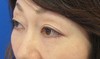 DR　近藤オリジナル　切らない目の下のクマ・たるみ取り　マイクロサージャリー（顕微鏡手術）