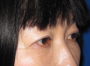 目の下の膨らみと凹みが混在した方に　切らない目の下のクマ・たるみ取り　TCB-R　コンプリート法　