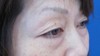 DR　近藤オリジナル　切らない目の下のクマ・たるみ取り　マイクロサージャリー（顕微鏡手術）