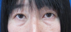 目の下の膨らみと凹みが混在した方に　DR.近藤オリジナル　TCB-R法